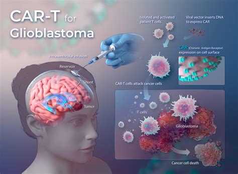 City of Hope Seeks to Advance Glioblastoma Treatment Through .